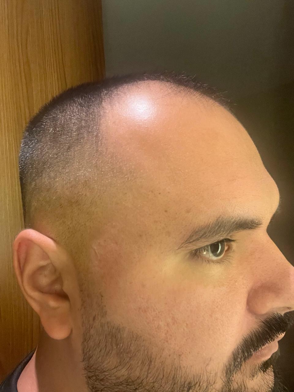Foto de perfil do noivo mostrando o cabelo raspado e ralo
